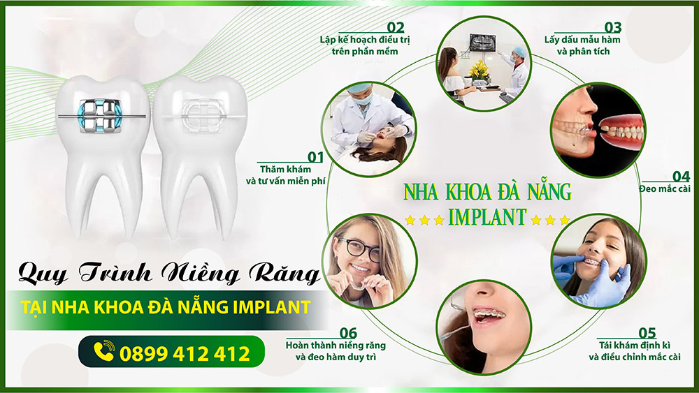 International standard braces slightly protrucding jaw procedure at Da Nang Implant Dental Clinic