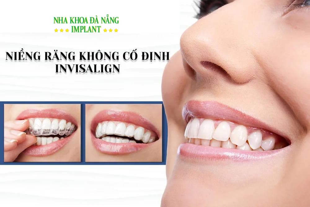 Invisalign non-fixed braces – convenient, painless, highly aesthetic