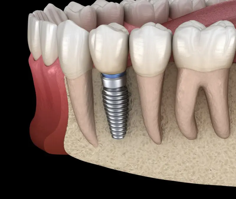 Is dental implant safe and what is the cost?
