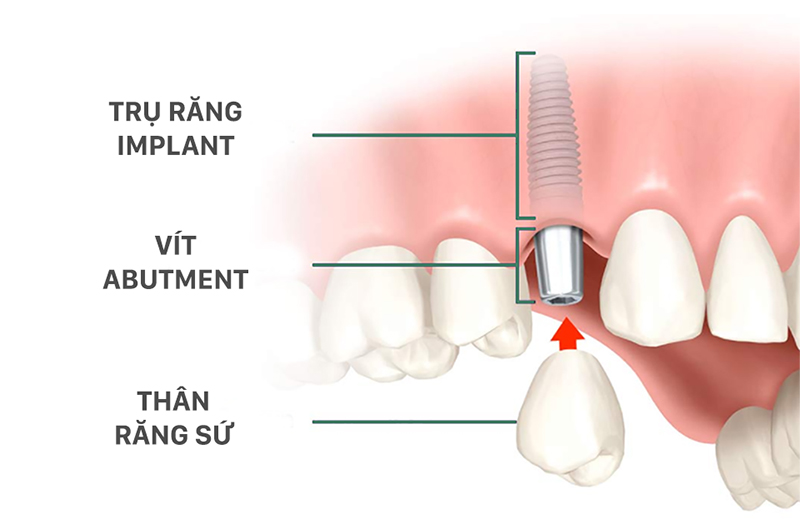 Trồng răng Implant bao lâu thì ăn được? Ăn gì và kiêng gì?