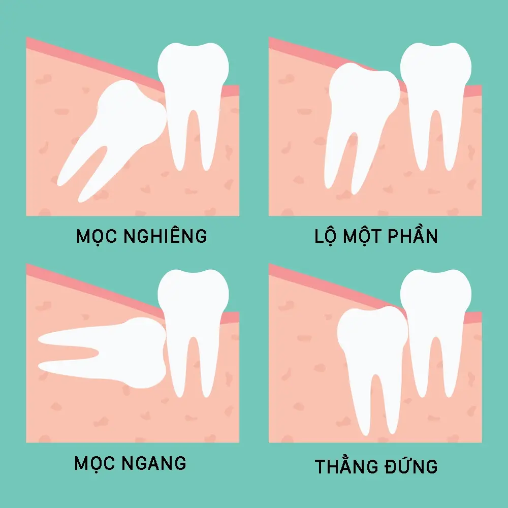 Trước khi nhổ răng khôn có cần nhịn ăn không?