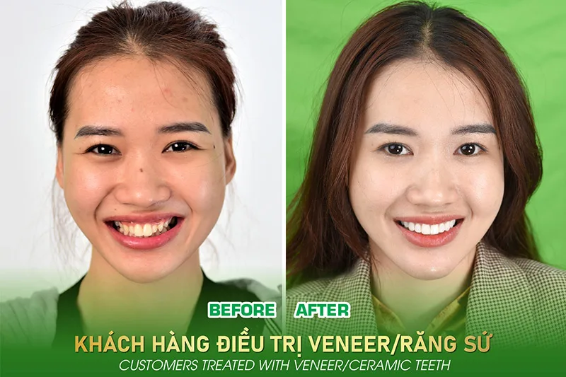 Porcelain Veneers / Ceramic Crowns Restoration