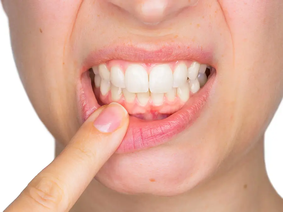 Ngứa chân răng gây nên cảm giác khó chịu hoặc rát ở chân răng. Nó có thể xảy ra ở một hoặc nhiều răng.