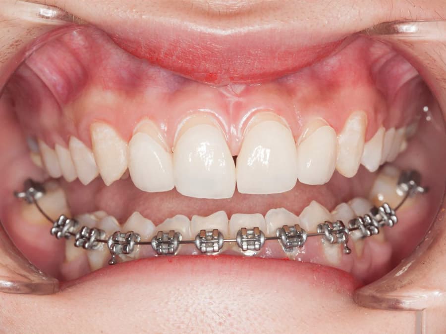 Các phương pháp niềng răng 1 hàm hiệu quả hiện nay