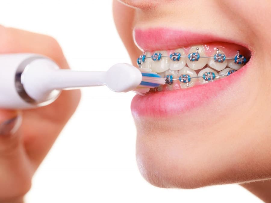 Đánh răng nhiều hơn 3 lần/ ngày là nguyên nhân phổ biến khiến người niềng răng bị ê buốt khi uống nước