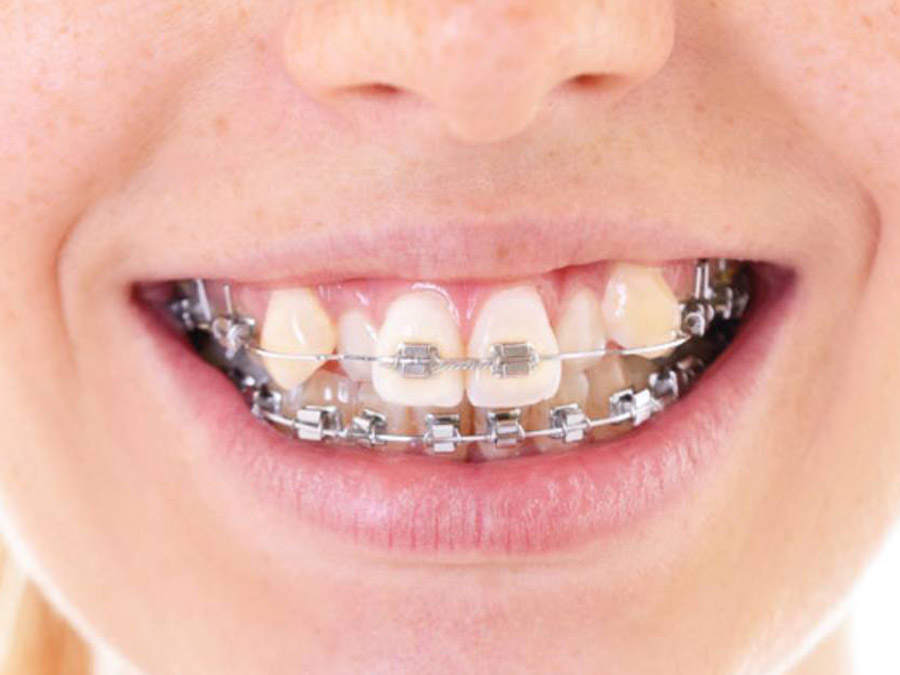 Niềng răng khểnh bao nhiêu tiền phụ thuộc vào phương pháp niềng răng mà bạn lựa chọn