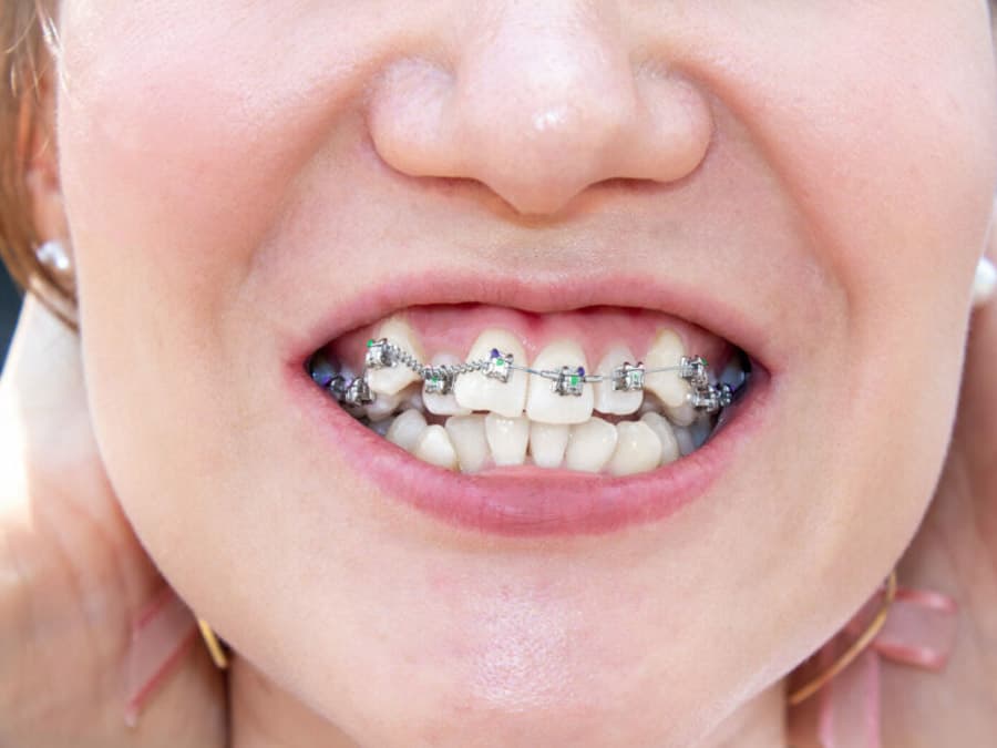 Một liệu trình niềng răng khểnh sẽ dao động trong khoảng 18 – 24 tháng, trường hợp răng phức tạp thì mất tới 36 tháng