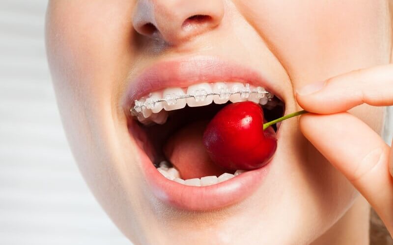 Niềng răng kiêng ăn gì? Gợi ý thực đơn 7 ngày cho người niềng răng đổi vị