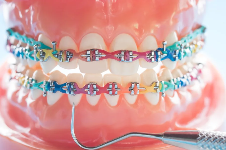 Bắt vít niềng răng là gì, cắm vít niềng răng có đau không?