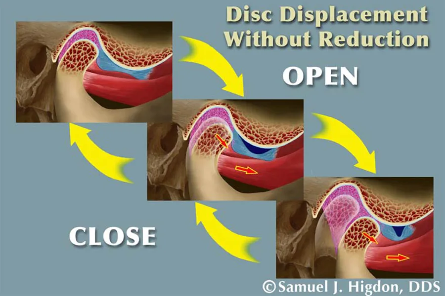 Há miệng có tiếng kêu nguy hiểm không?