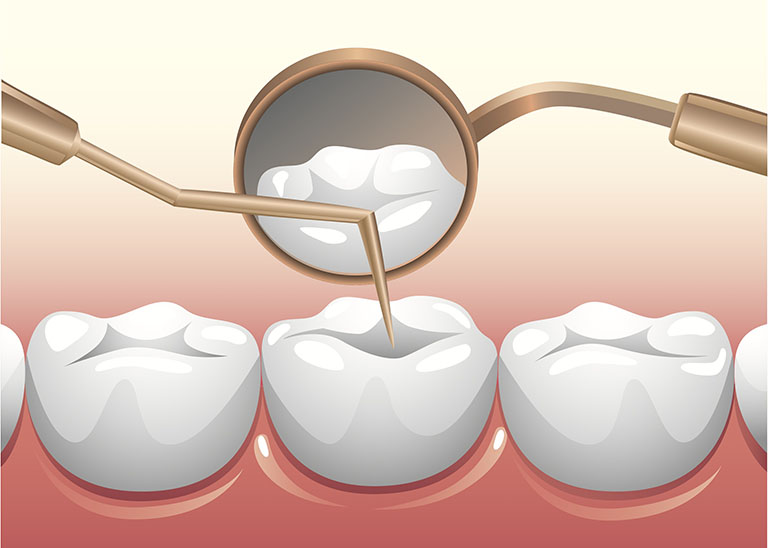 Có nên lấy tủy răng ở trẻ em không? Có ảnh hưởng răng vĩnh viễn không?