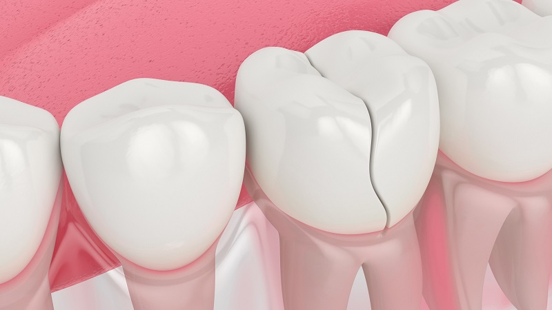 Răng bị nứt dọc có tự phục hồi được không? Cách điều trị