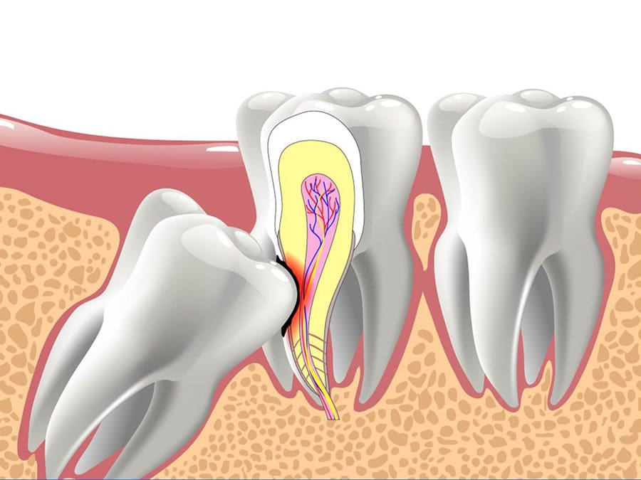 Có nhiều nguyên nhân gây nhiễm trùng sau khi nhổ răng khôn