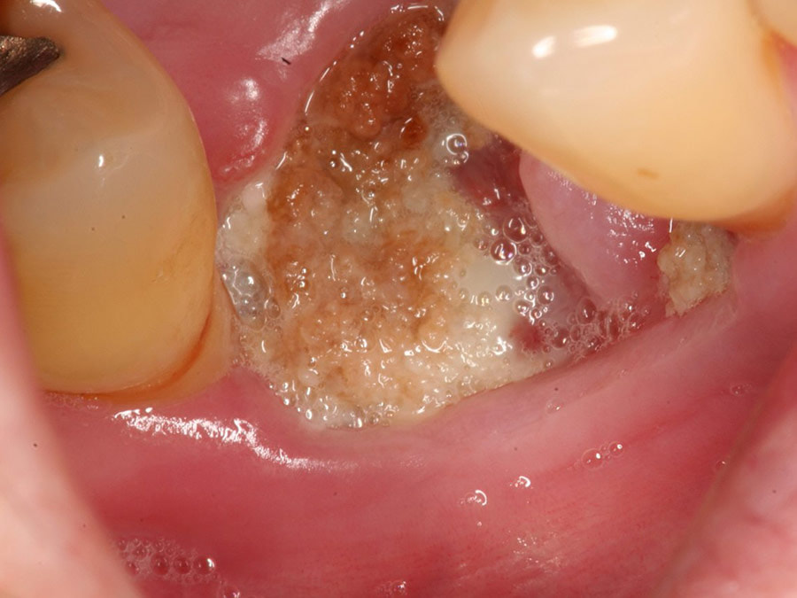 dấu hiệu nhiễm trùng sau khi nhổ răng khôn và cách xử lý kịp thời