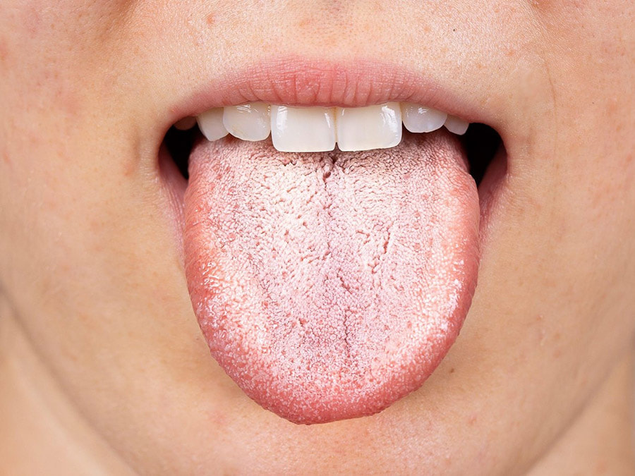 Nấm lưỡi là tình trạng tưa lưỡi do nấm Candida albicans gây nên