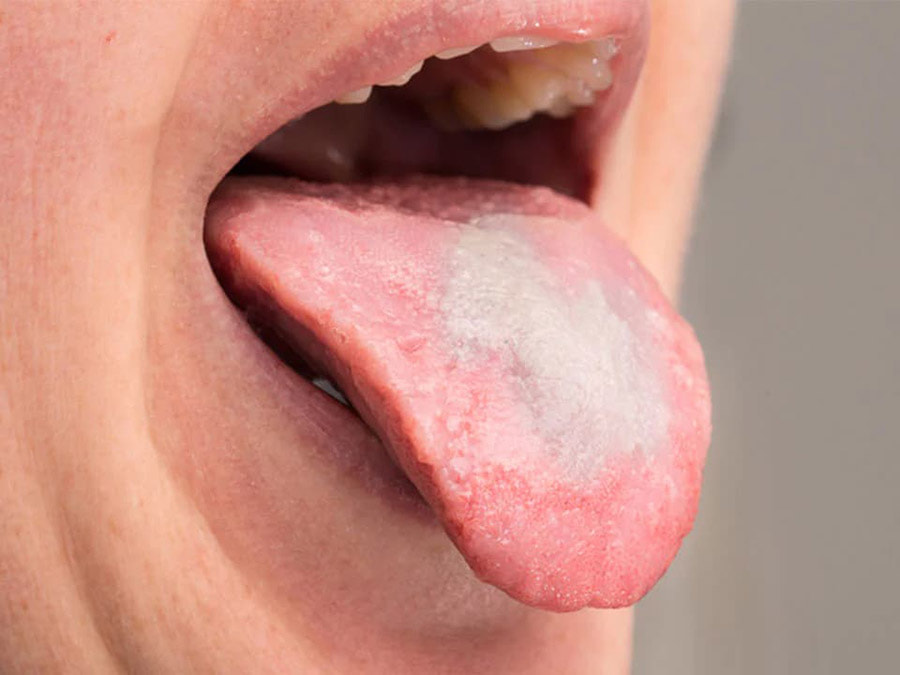 triệu chứng và dấu hiệu của bệnh nấm lưỡi Candida albicans