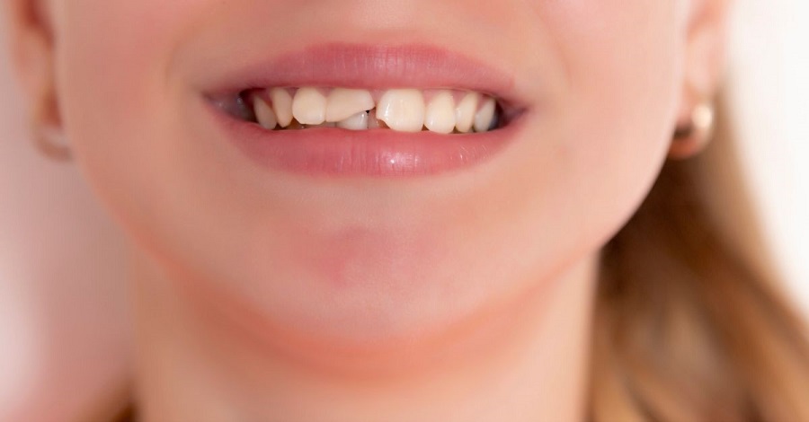 Răng bị mẻ là thiếu chất gì? Có thể khắc phục được không?
