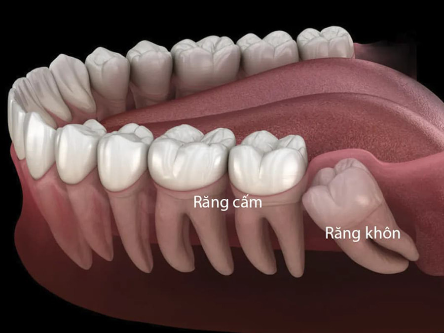 Răng cấm là răng gì? Mọc ở đâu và khác gì với răng khôn?
