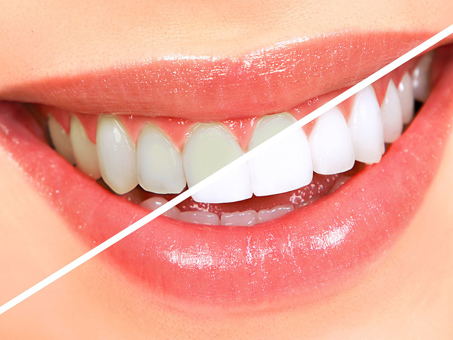 Tẩy trắng răng dùng thuốc hóa học cùng ánh sáng xanh để làm gãy chuỗi protein, giúp cho răng trắng sáng hơn