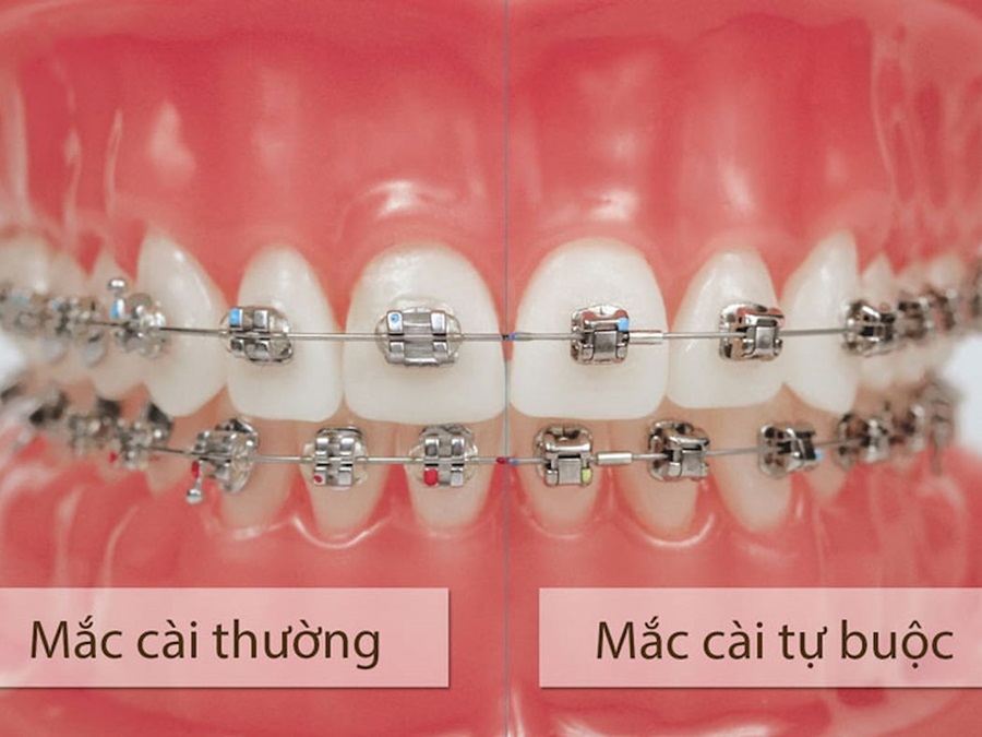 Niềng răng bao lâu thì tháo? Cách rút ngắn thời gian niềng răng chỉnh nha