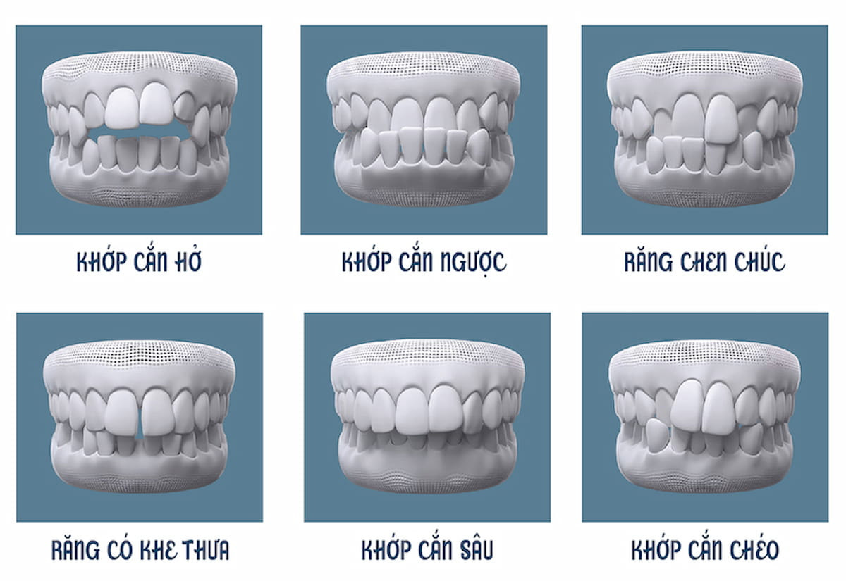 Kỹ thuật niềng răng hiện đại được phát minh vào năm 1819 bởi Christophe-Francois Delabarre.