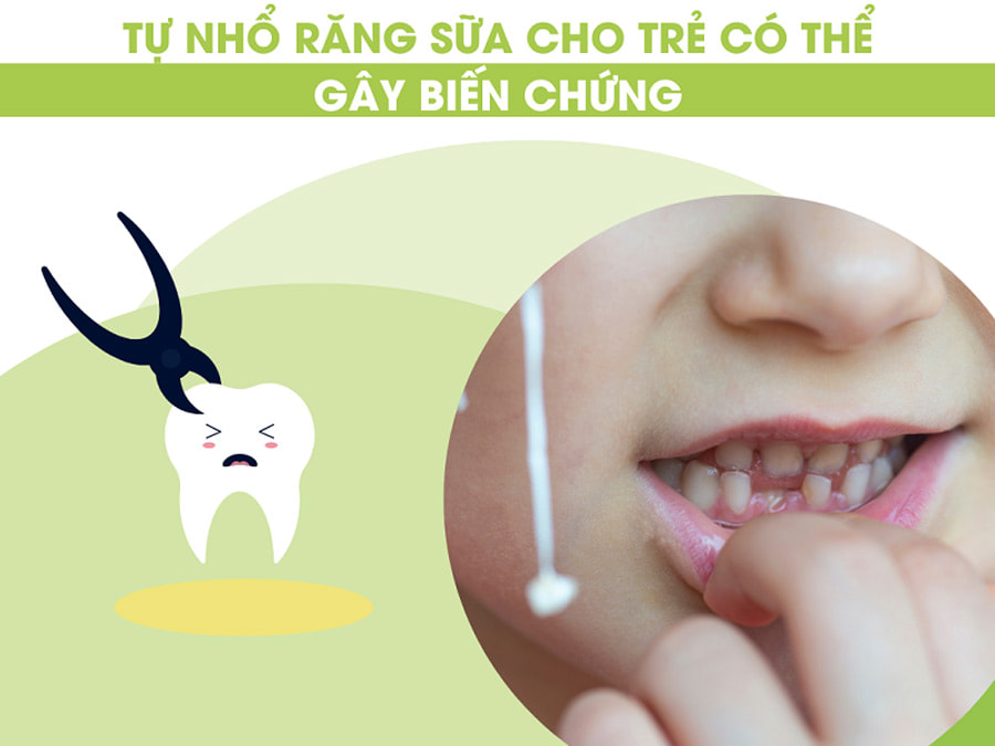 Có nên tự nhổ răng sữa cho trẻ tại nhà không?