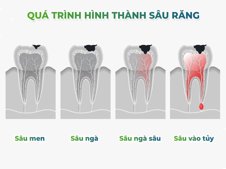 Để xác định mức độ răng bị thủng lỗ, bạn sẽ cần đến nha khoa để được thực hiện một số xét nghiệm và kiểm tra trên răng