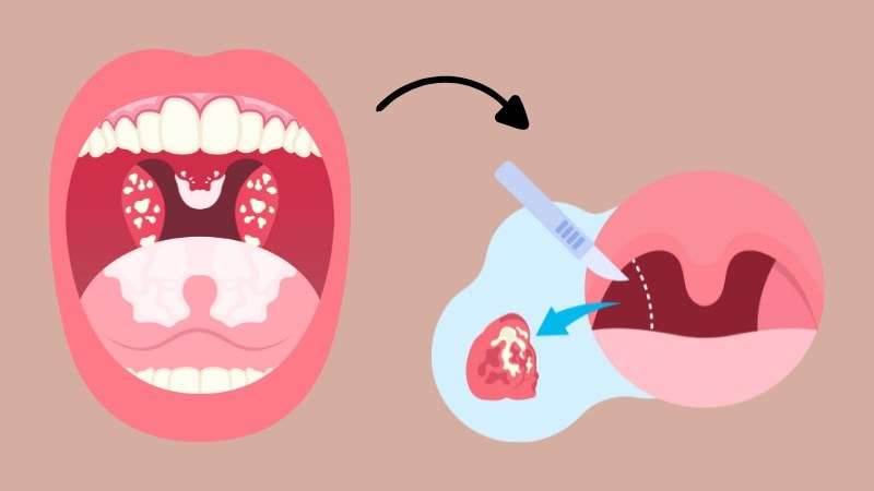 Viêm amidan có thể gây ra nhiều biến chứng nguy hiểm