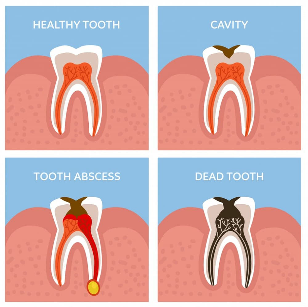 Răng chết tủy là giai đoạn cuối của tình trạng viêm và nhiễm trùng do các tổn thương nặng không được điều trị kịp thời, dẫn đến tình trạng chết tuỷ.