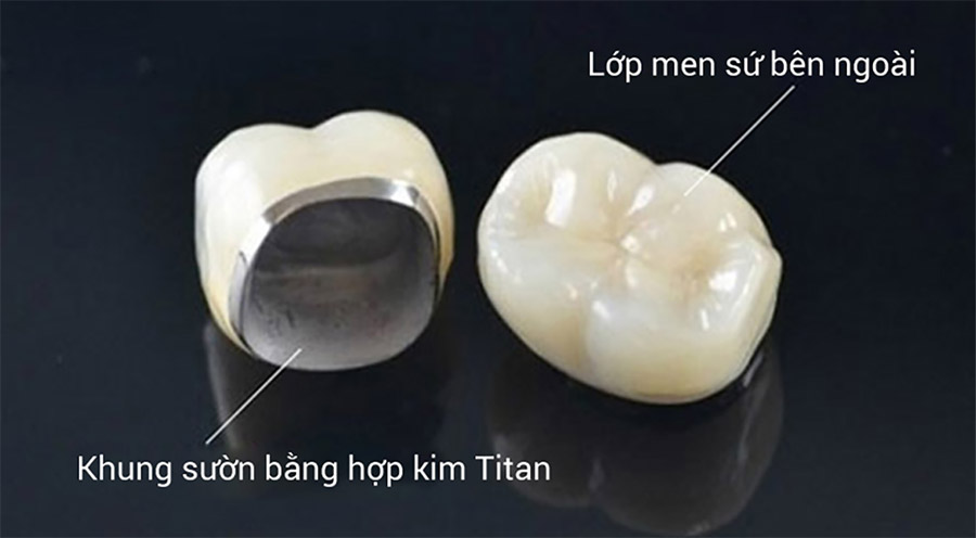 Răng sứ là một loại răng giả có hình dáng, màu sắc và kích thước được tạo ra gần giống với răng thật.