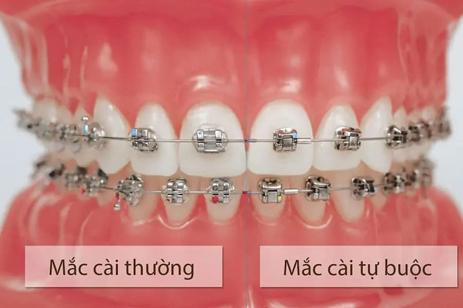 So sánh mắc cài bằng thường và mắc cài tự buộc