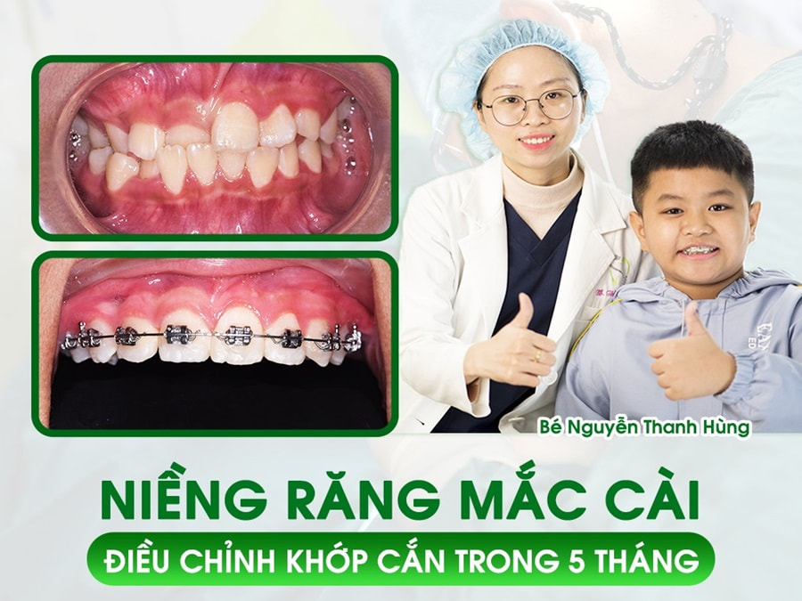 Giá niềng răng mắc cài cố định bao nhiêu tiền tùy vào chất liệu khí cụ và kỹ thuật thực hiện