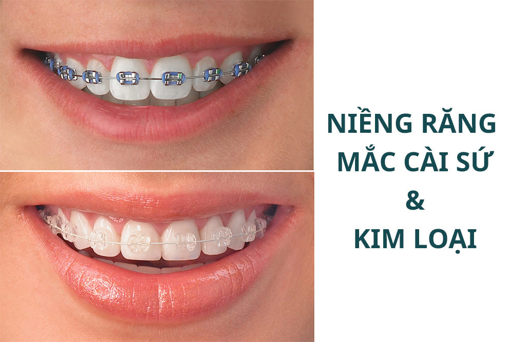 Niềng răng mắc cài sứ truyền thống và mắc cài kim loại