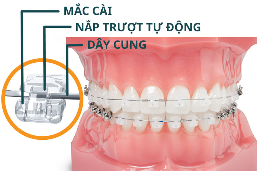 Niềng răng mắc cài sứ tự buộc