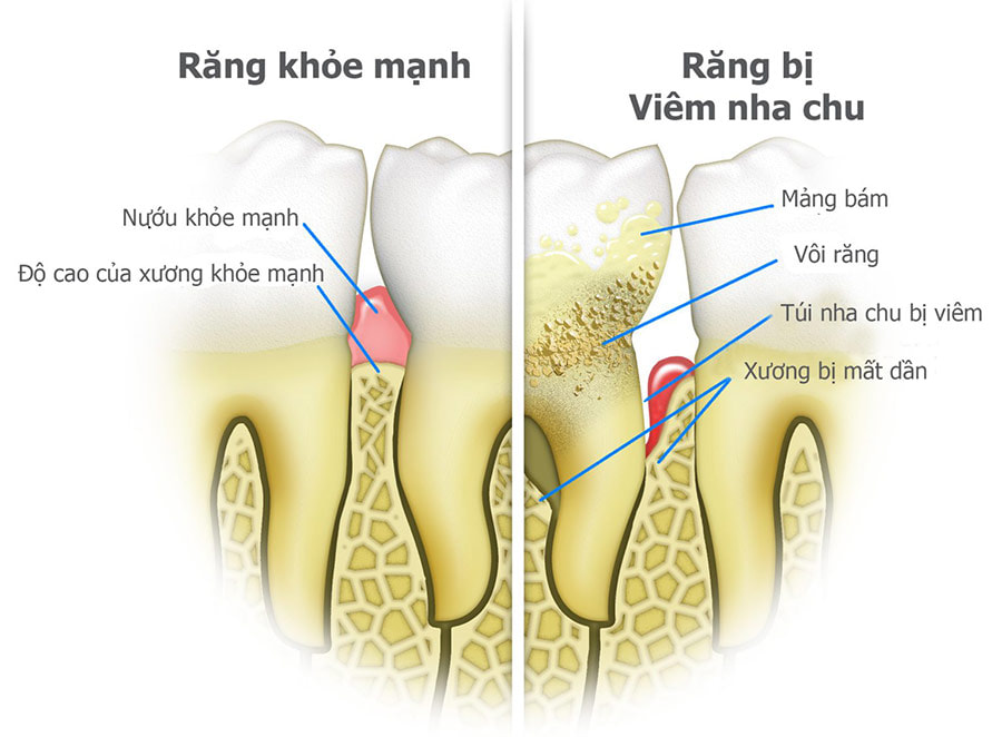 Răng lung lay làm sao để chắc lại?