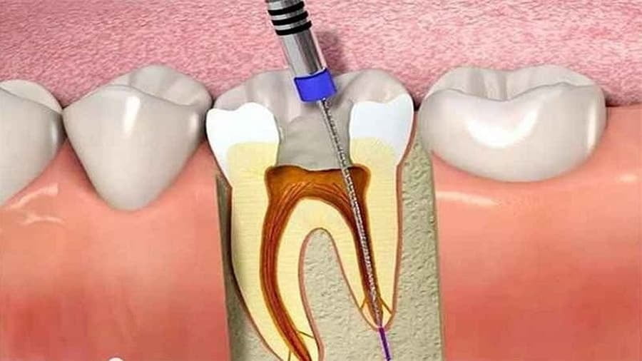 Cách điều trị sâu răng cửa sâu bằng điều trị tuỷ