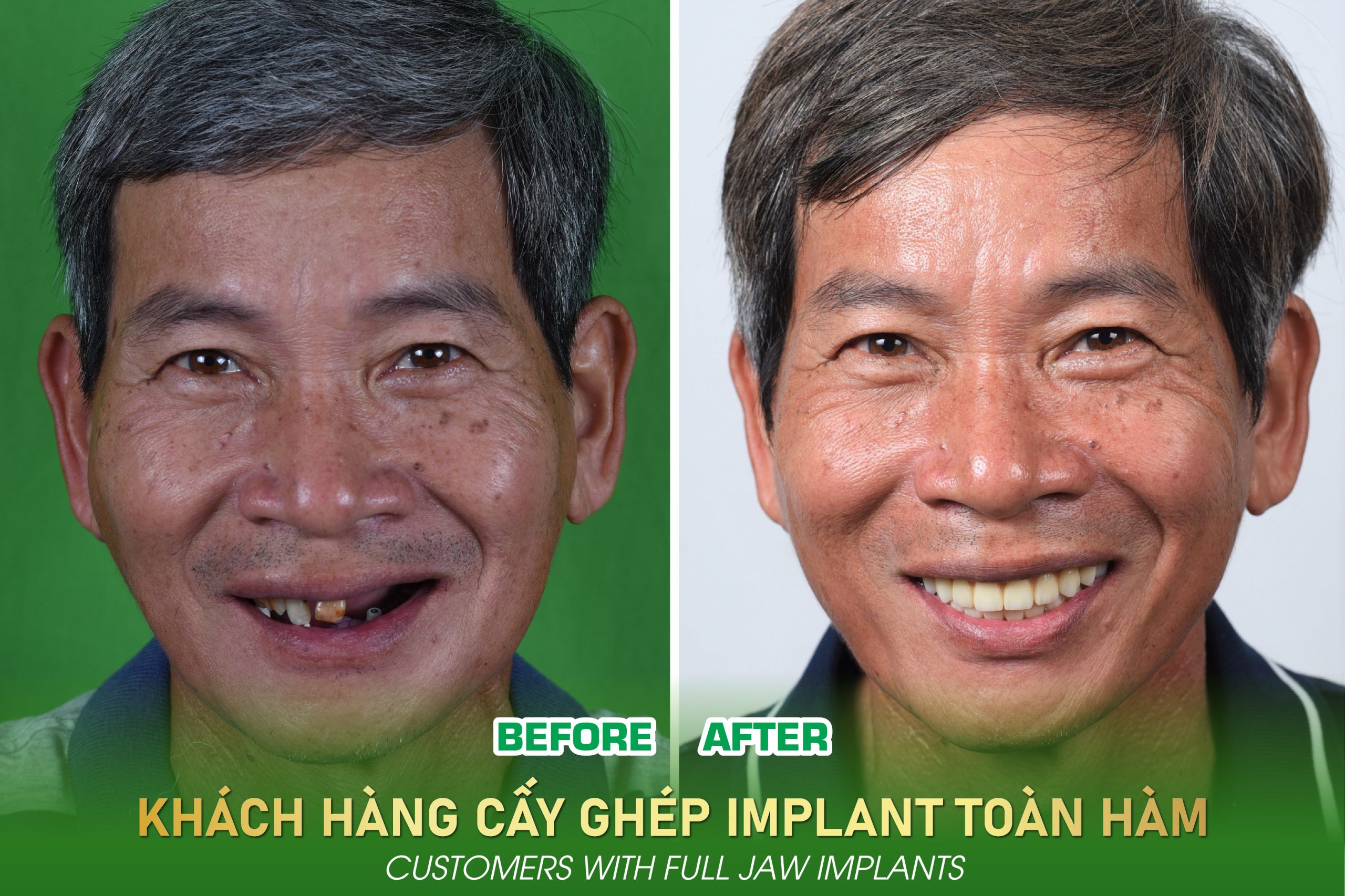 Cấy ghép Implant toàn hàm