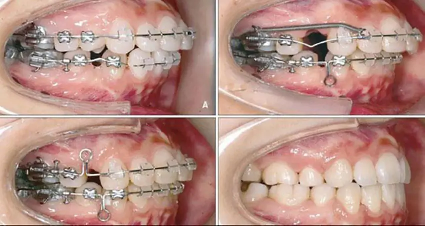 Đóng khoảng trống trong niềng răng