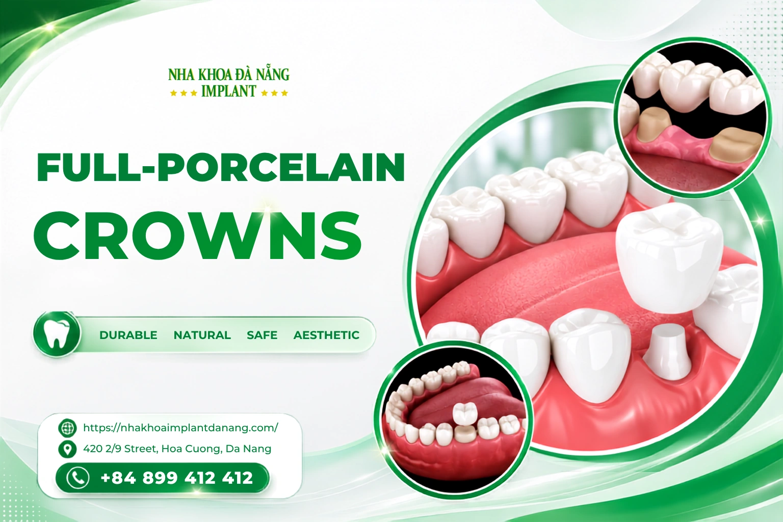 Full-porcelain crowns