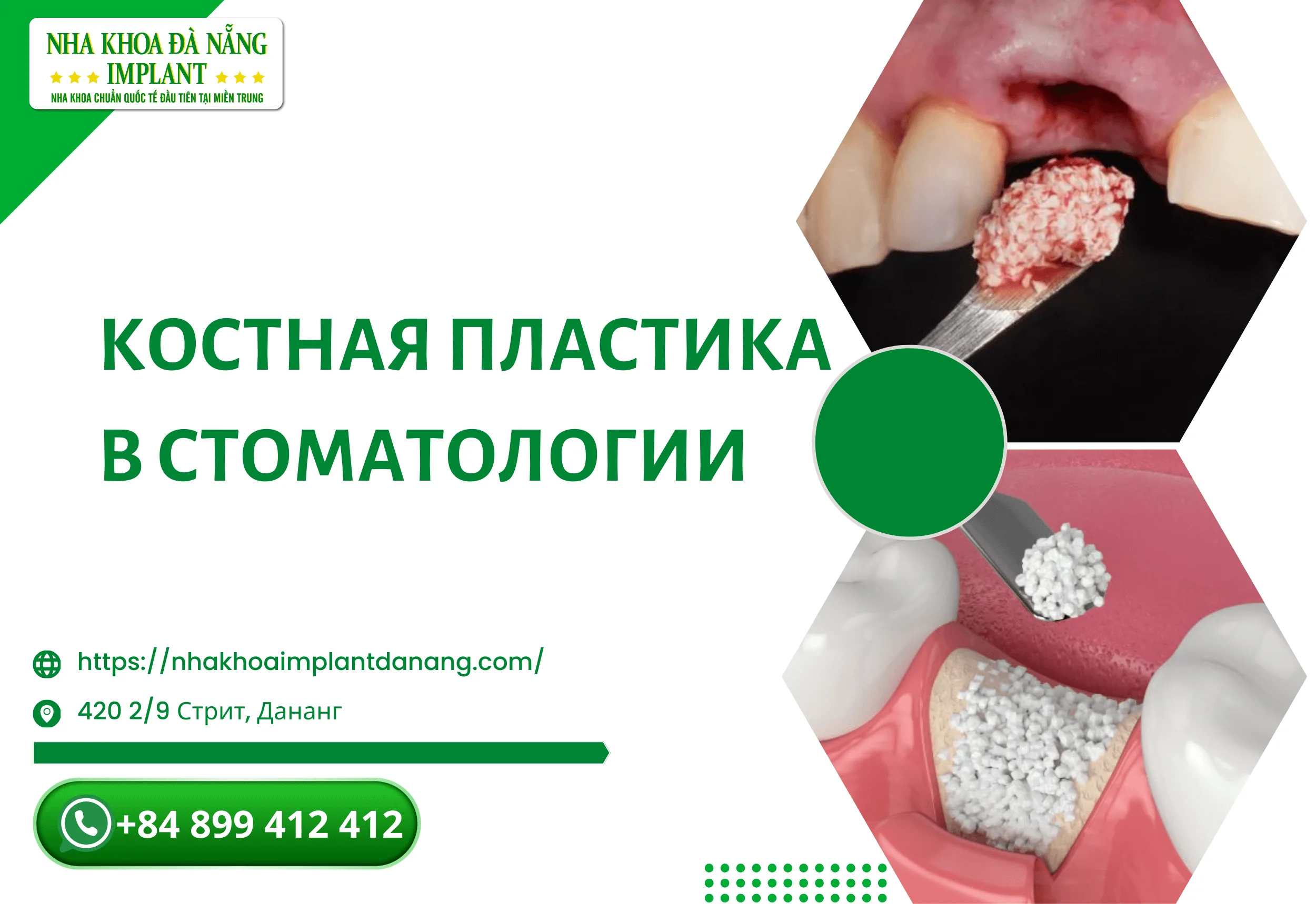 Костная пластика в стоматологии