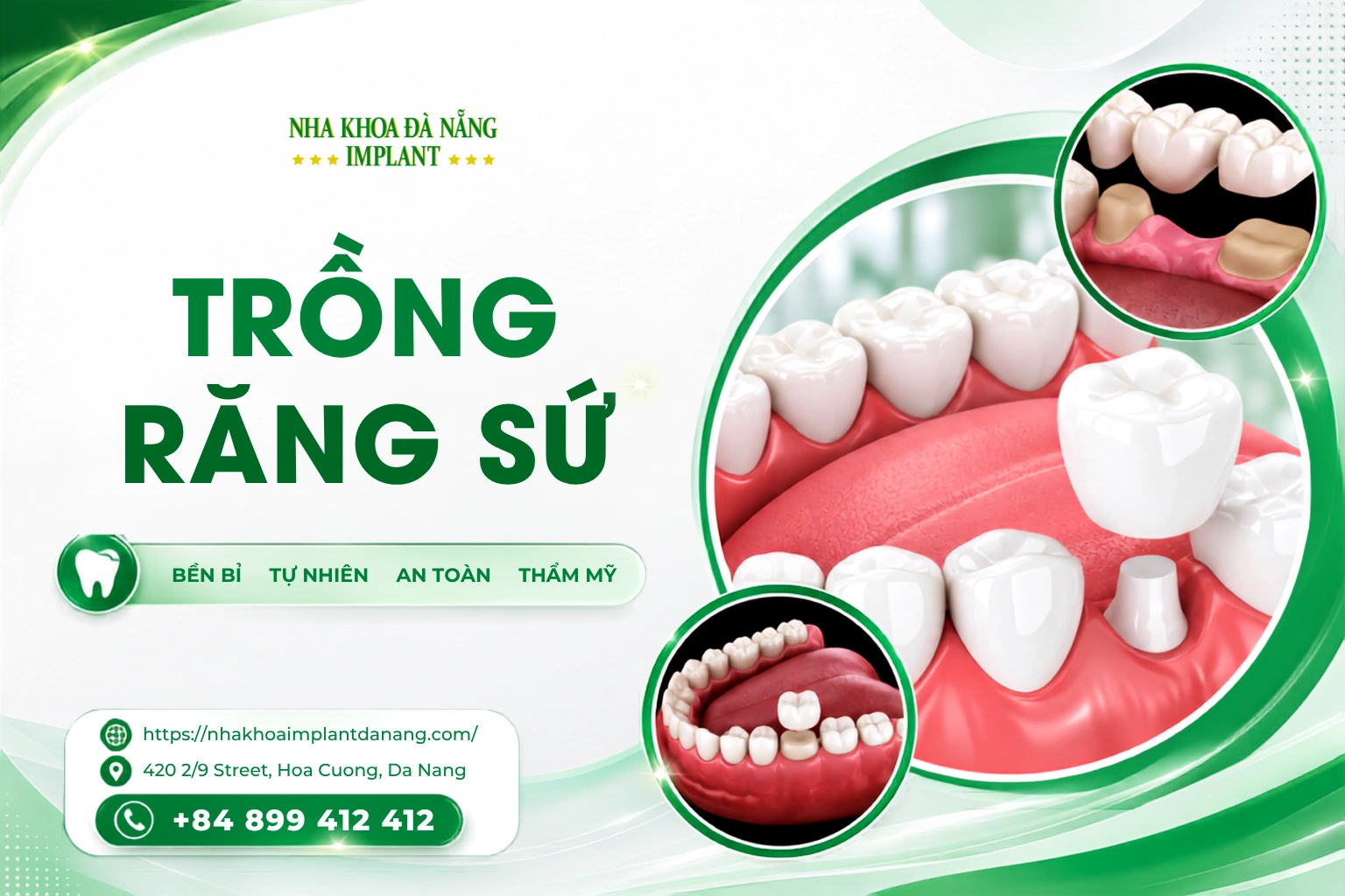 Trồng răng sứ