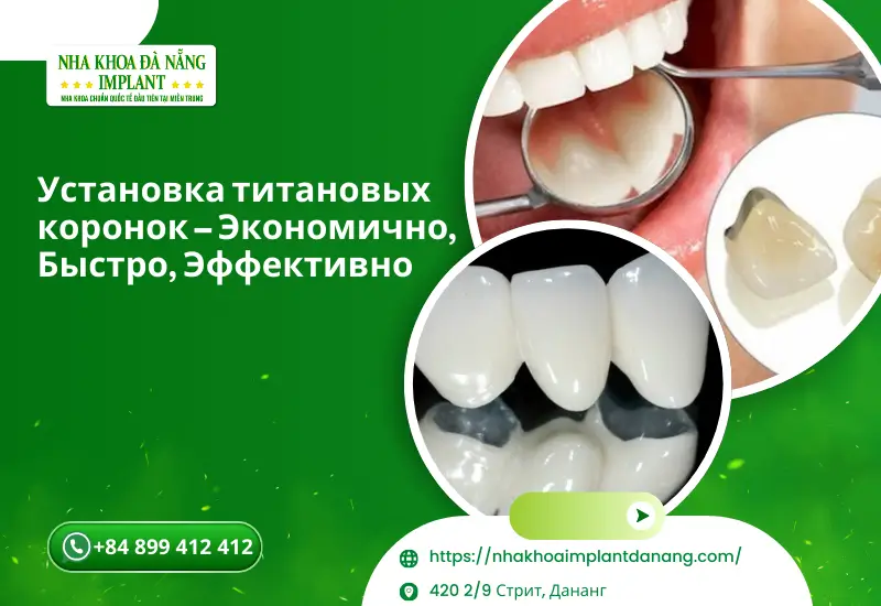 Установка титановых коронок – Экономично, Быстро, Эффективно