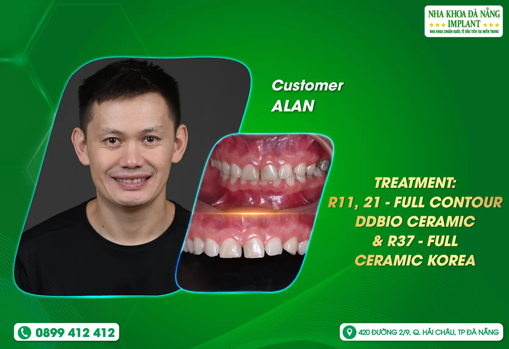 [Feedback] Satisfying old customers and pleasing new customers is the top priority of Danang Implant Dental Clinic
