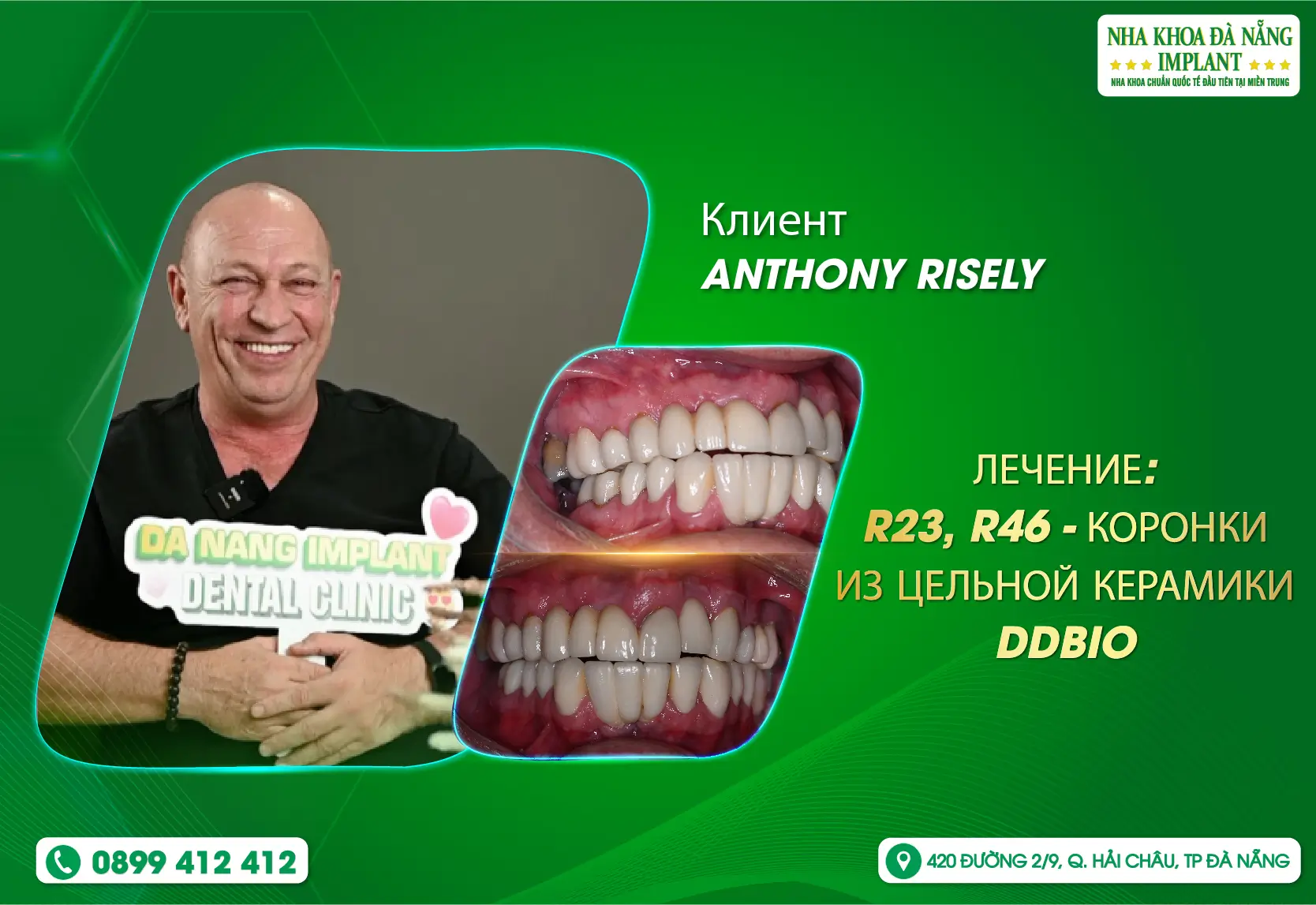 [Отзыв] Обслуживание клиентов — это одно из преимуществ Da Nang Implant Dental Clinic