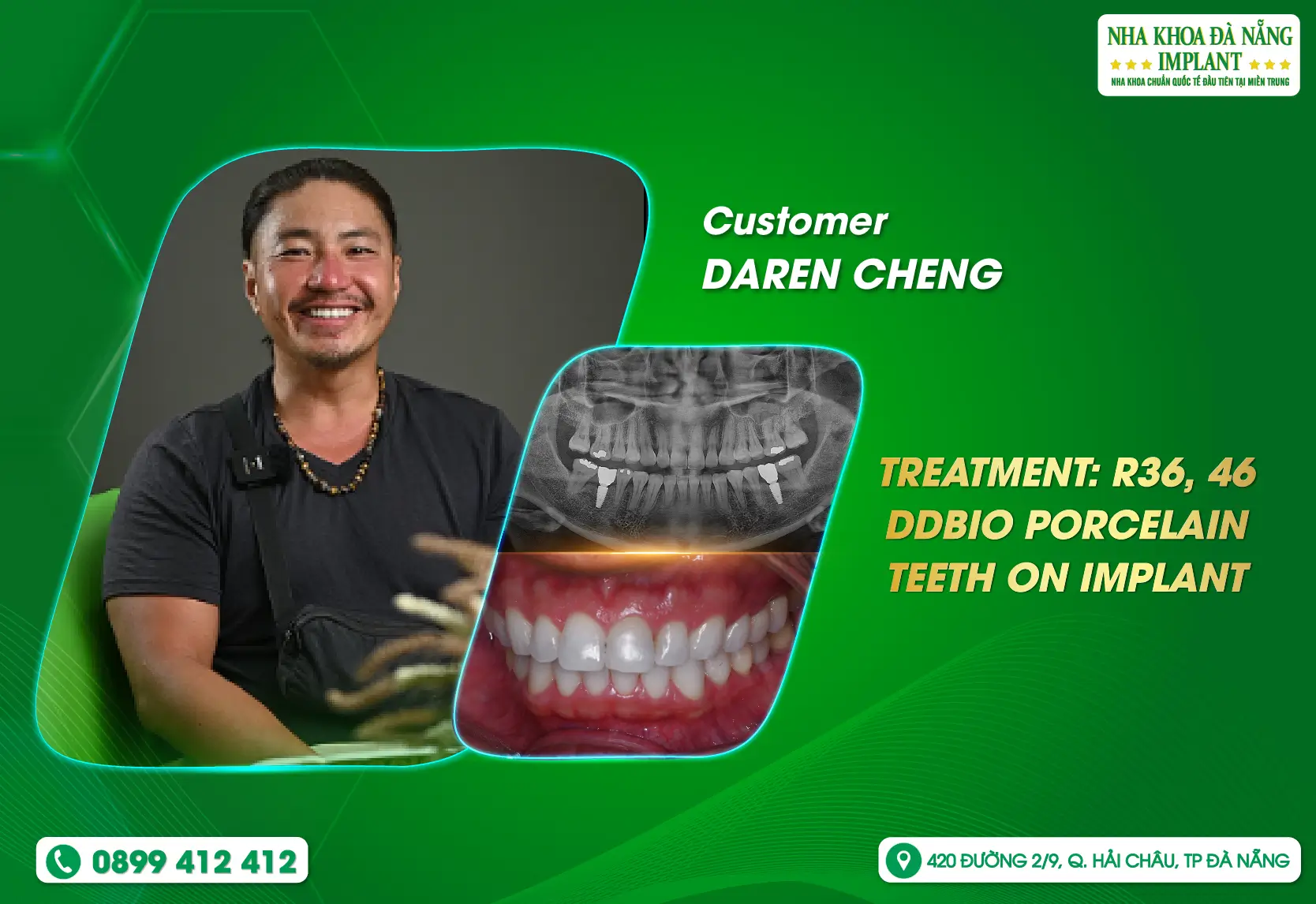 [Feedback] Why do foreign customers trust and choose Danang Implant Dental Clinic?
