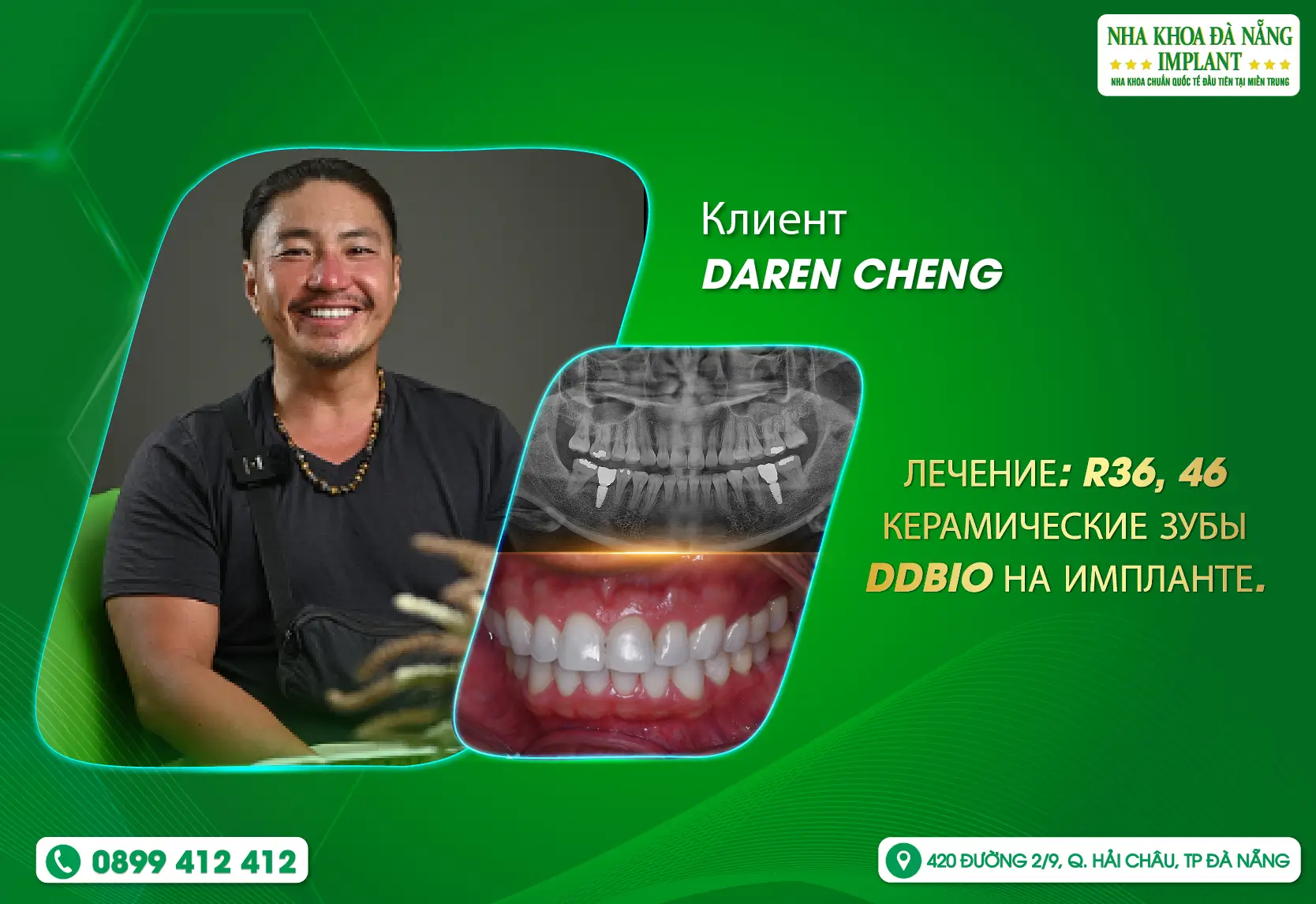 [Отзыв] Почему иностранные клиенты доверяют и выбирают Da Nang Implant Dental Clinic?