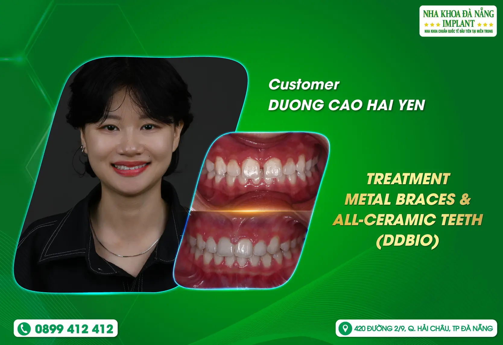 [Feedback] Get a confident smile with metal braces
