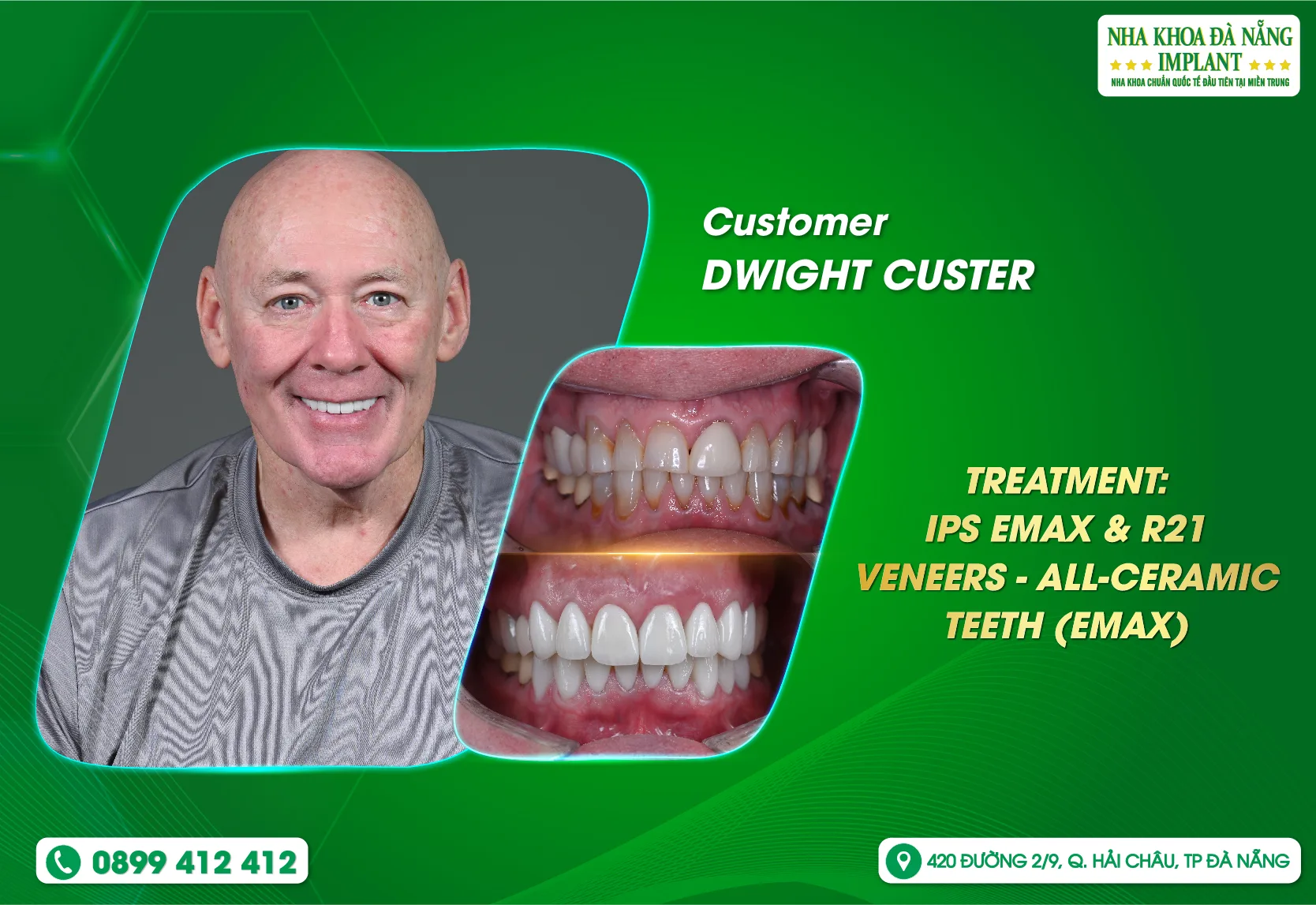 [Feedback] Want to chew healthily - choose Da Nang Implant Dental Clinic