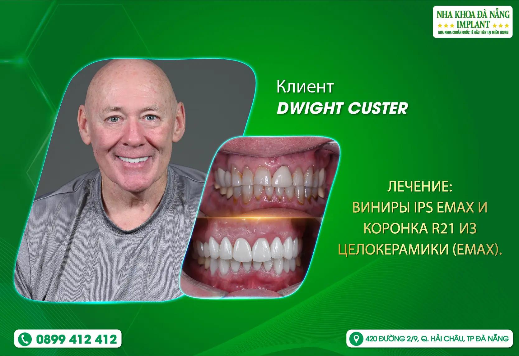 [ОТЗЫВ] Хотите жевать здорово — выбирайте Da Nang Implant Dental Clinic