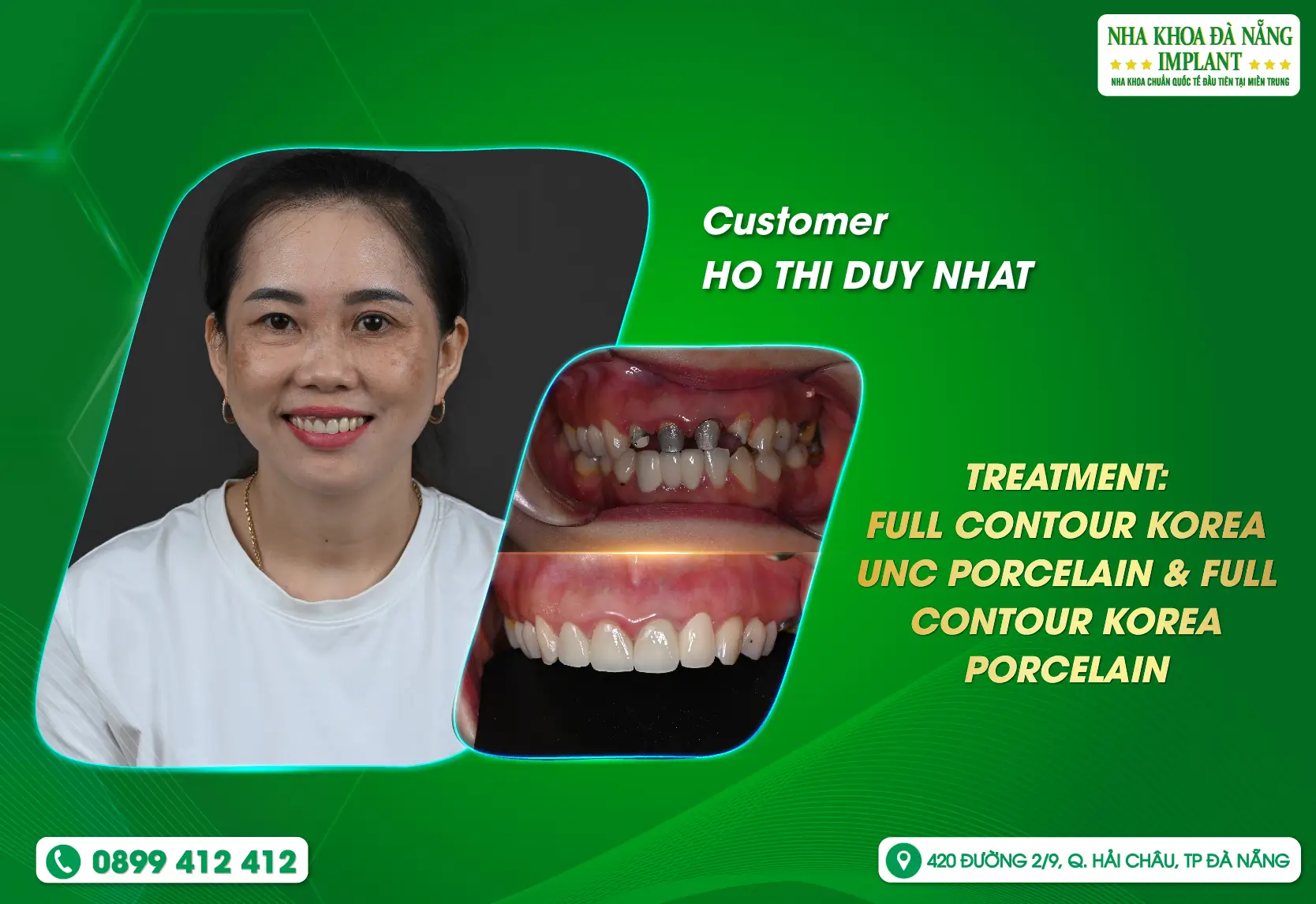 [Feedback] Find a bright smile at Danang Implant Dental Clinic